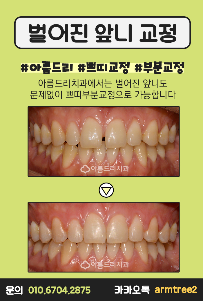 치아벌어짐 치아교정사랑니 아름드리 관련 이미지 4