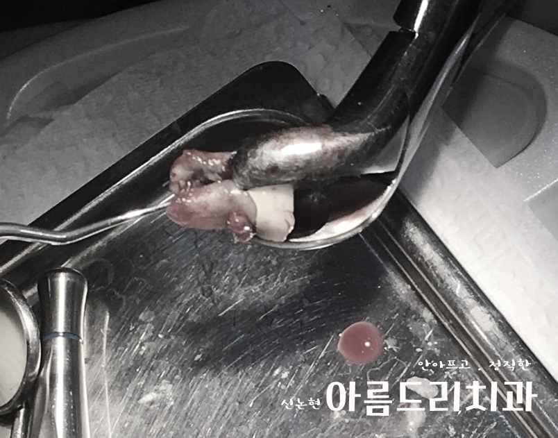 치아재식_임플란트 안 하고 치아 살릴 순 없나요?(신논현역 치과) 관련 이미지 10