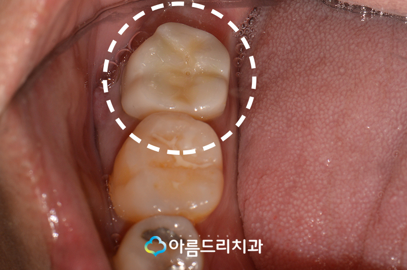 치아재식술 자연치아살리기 관련 이미지 4