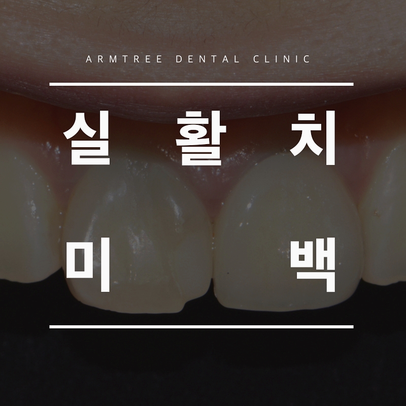 실활치미백 앞니변색후기 신논현역 아름드리치과 관련 이미지 1