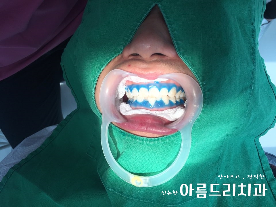 신논현역치과 아름드리치과에서 건강한 치아미백, 전문가 미백 관련 이미지 7