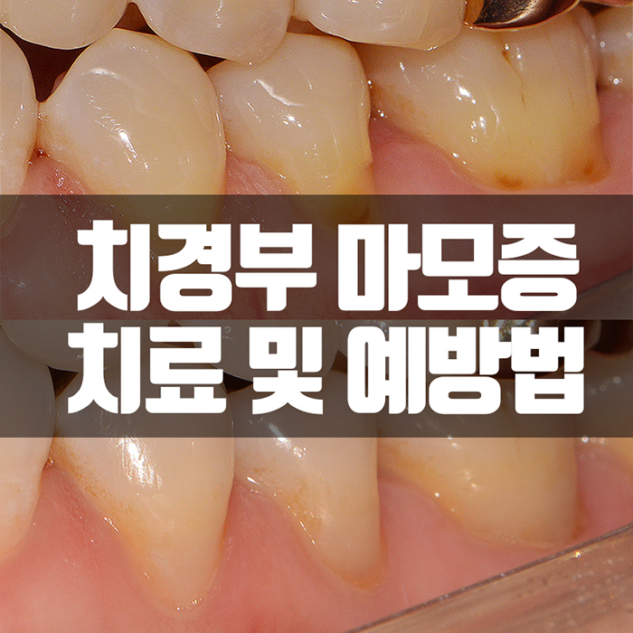 치경부마모증 잇몸파임 시린이 치료 관련 이미지 1