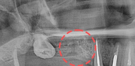 신논현역임플란트 아름드리치과에서 상악동거상술이 필요하면 관련 이미지 6
