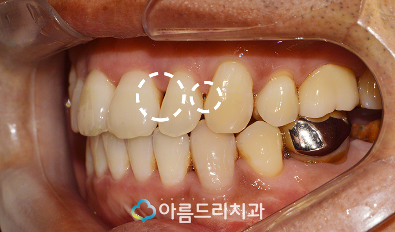 앞니블랙트라이앵글 치료 치아 후기 관련 이미지 5