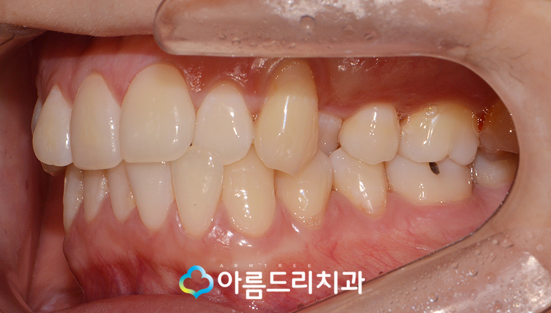 치아부정교합교정 악궁확장장치 후기는? 관련 이미지 4