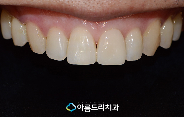 앞니깨짐 치료후기 해결책 관련 이미지 8