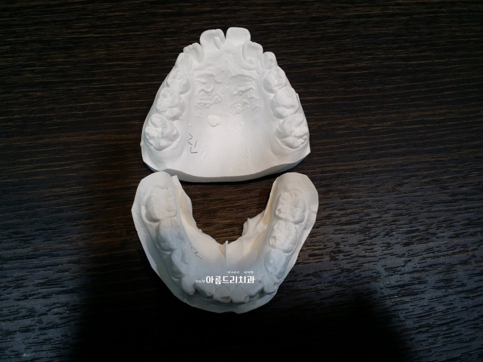 신논현치과 치아교정_앞니교정 계획 중이신가요? 관련 이미지 4