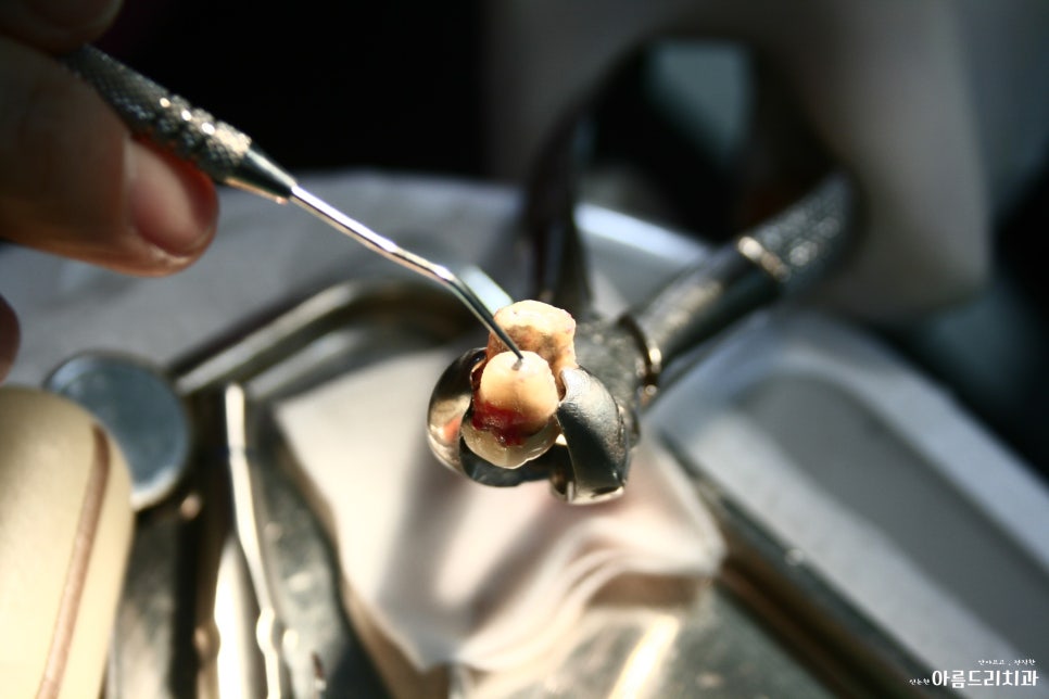 치아재식_임플란트 안 하고 치아 살릴 순 없나요?(신논현역 치과) 관련 이미지 15