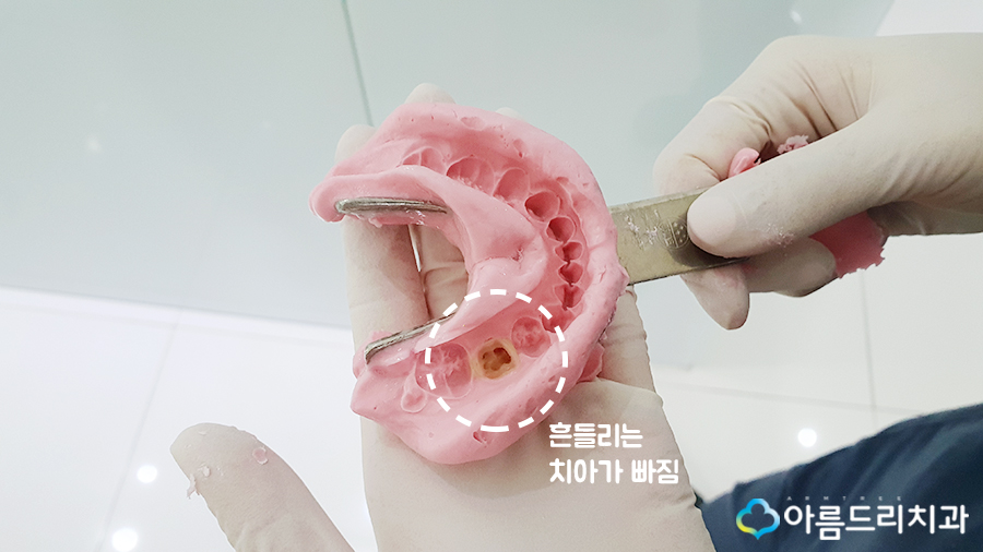 어린이치아교정 부정교합 리얼스토리#2 관련 이미지 6