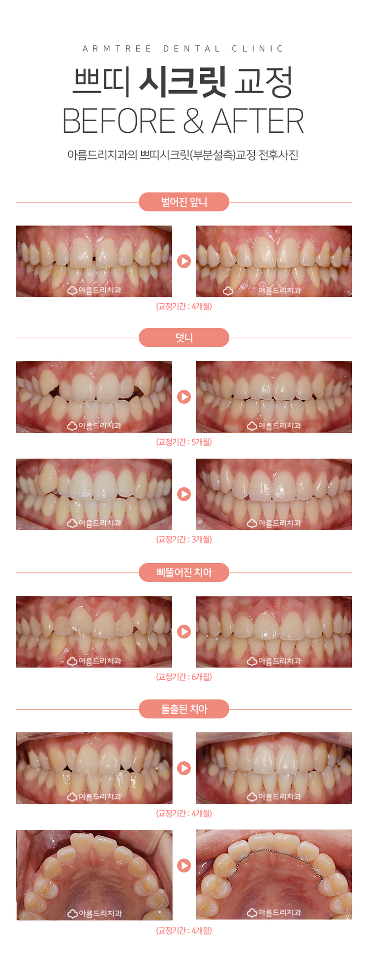 설측교정 후기앞니 단기간에 관련 이미지 9