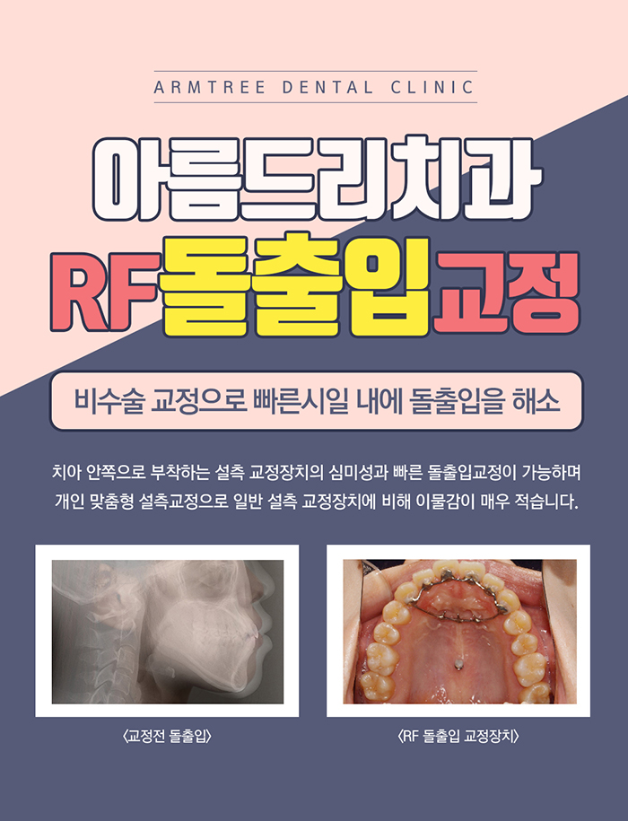 입툭튀교정 돌출입치아교정전후 실화냐? 관련 이미지 3