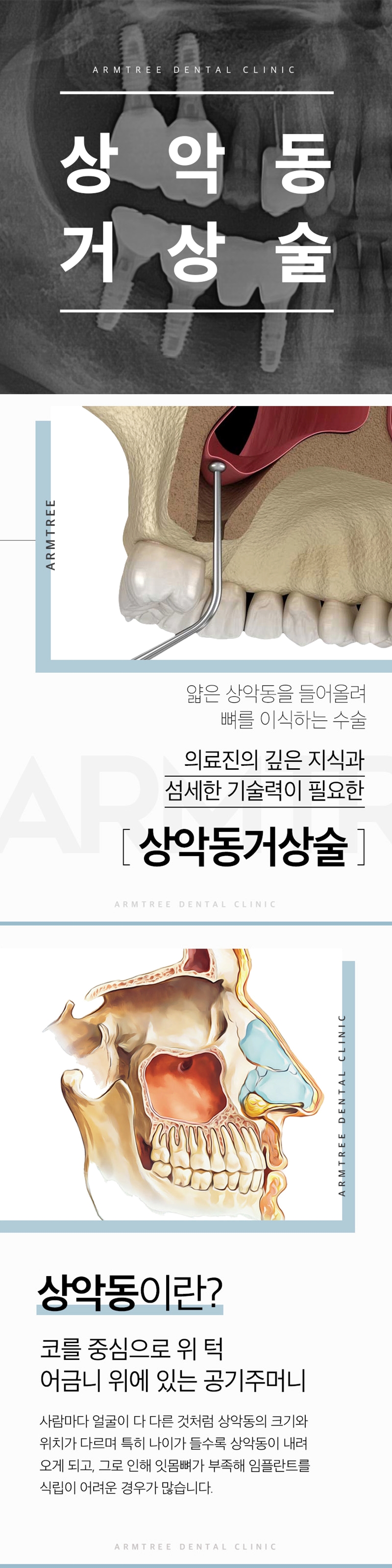 반포치과 임플란트 상악동거상술이 필요하다면 관련 이미지 1