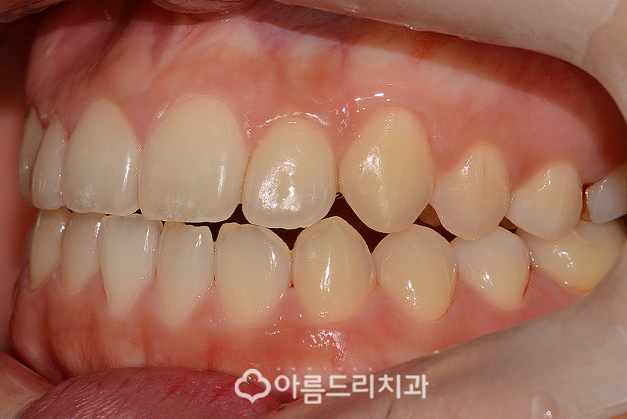 앞니부분교정기간 후기의 변화 관련 이미지 8