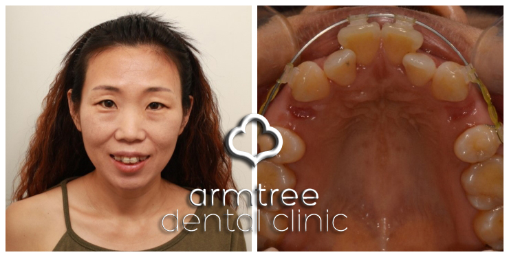 이현정원장의 아름다운 당신 시즌 1(4회 박효남 도전자) 돌출입 치아교정 관련 이미지 10