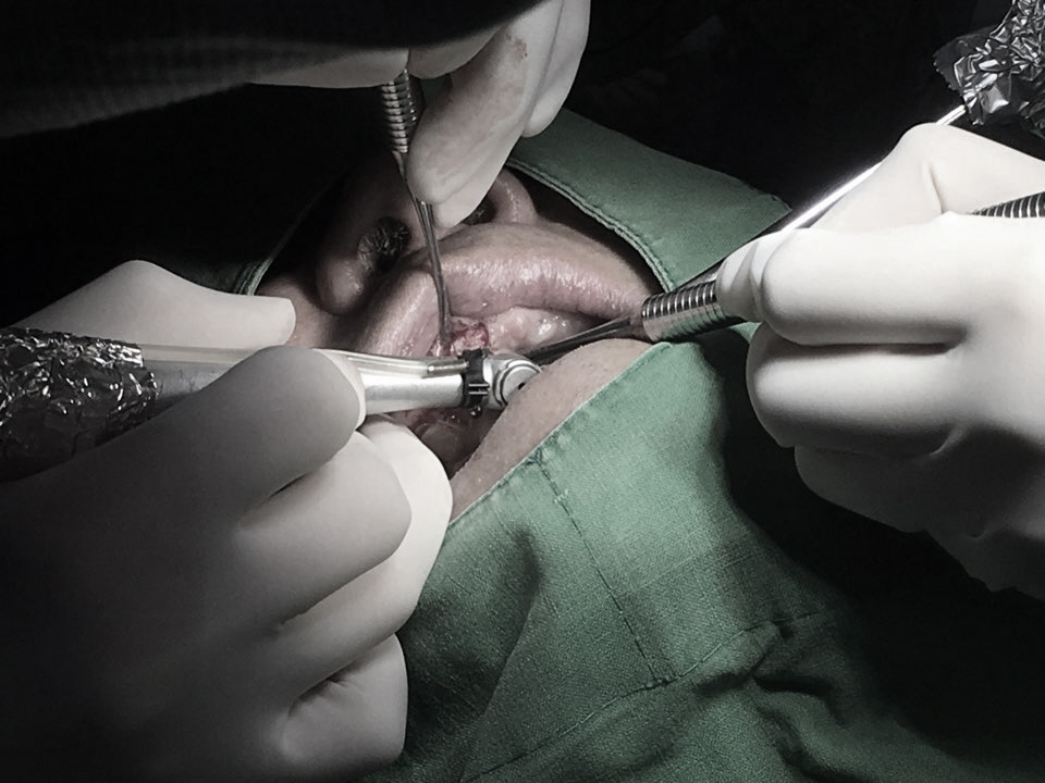 앞니 임플란트_뼈이식_신논현역 치과_아름드리 치과 관련 이미지 5