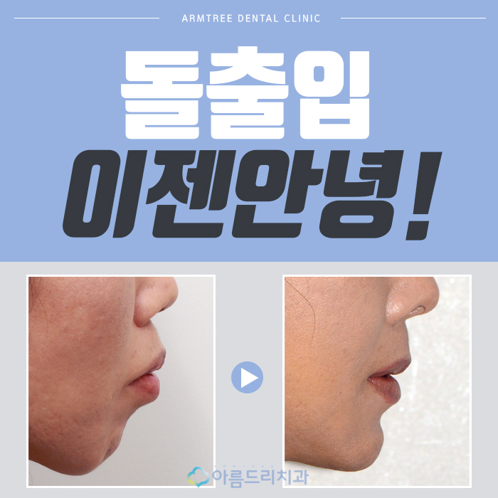 치아교정얼굴변화 어떠한가? 관련 이미지 1
