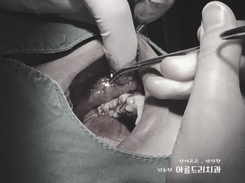 치아재식_임플란트 안 하고 치아 살릴 순 없나요?(신논현역 치과) 관련 이미지 24