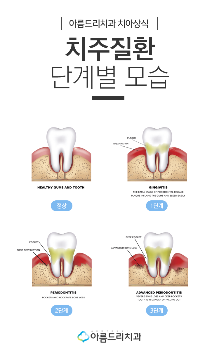 인사돌 이가탄 효과와 잇몸약, 치과에서 바라보다! 관련 이미지 4