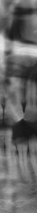 신논현역치과 사랑니 발치를 원한다면 관련 이미지 10