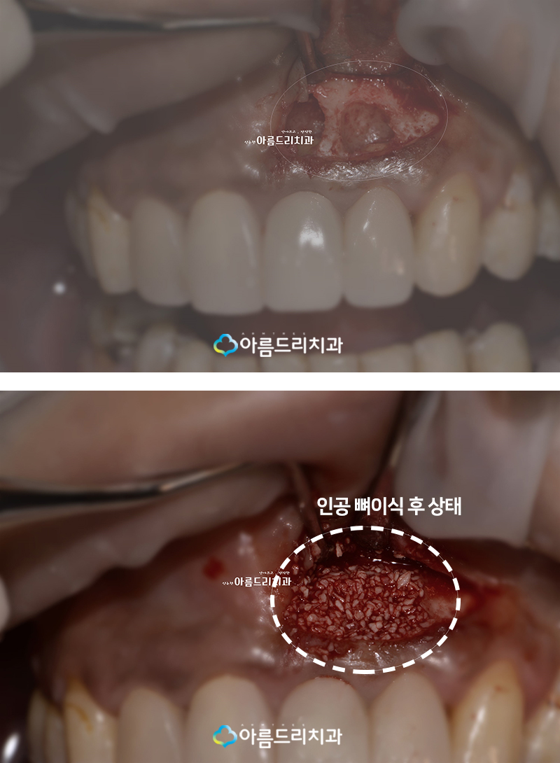 치근단절제술 후기를원한다면? 관련 이미지 8