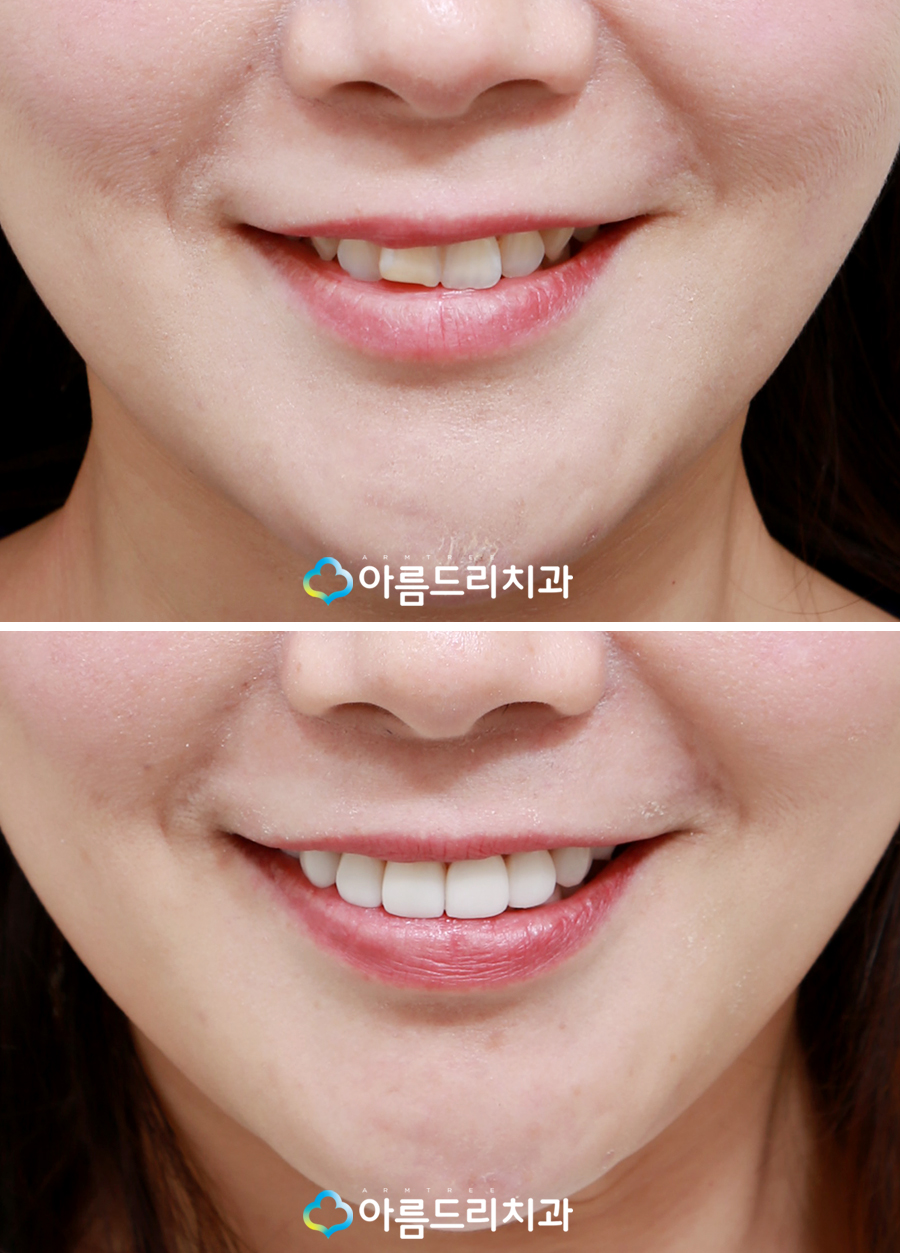 치아라미네이트 삭제량이 초중요 관련 이미지 10