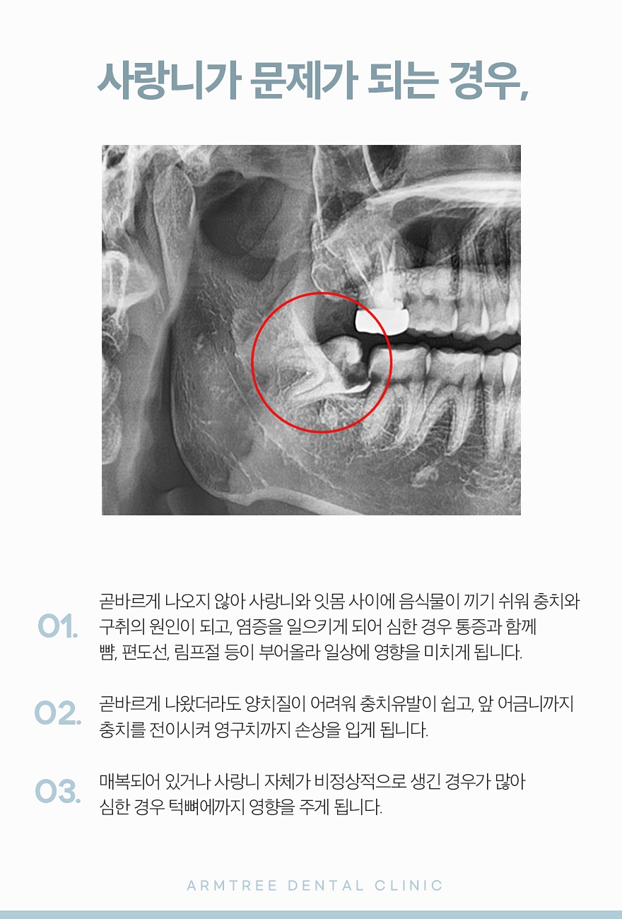 신논현 사랑니발치 선택하려면 관련 이미지 4