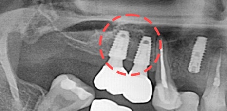 신논현역임플란트 아름드리치과에서 상악동거상술이 필요하면 관련 이미지 12