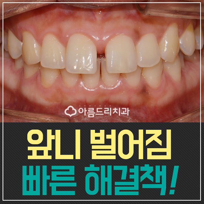 앞니 벌어짐 교정 빠른해결책 관련 이미지 1