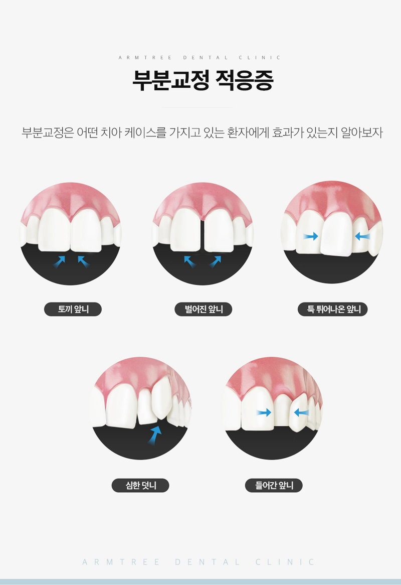 아랫니부분교정 아랫니만 가능한 아름드리치과 관련 이미지 7