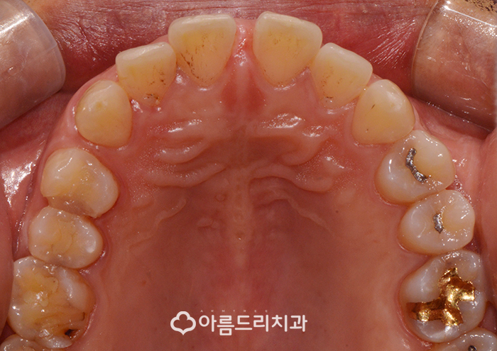 앞니 벌어짐 교정 빠른해결책 관련 이미지 3
