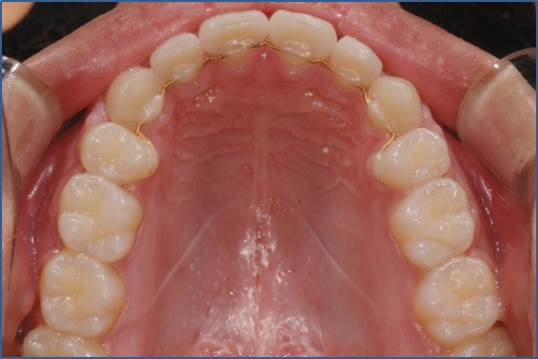 교정 완료_유지 장치 어떤 거 해야 해? 관련 이미지 7