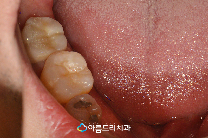 치아재식술 후기 자연치아지키기 관련 이미지 11