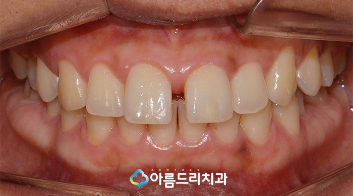 부분치아교정 앞니벌어짐 부분교정후기는! 관련 이미지 3