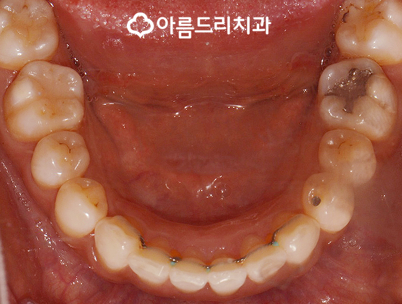 급속치아교정 코티코토미 피질골절단술 후기 관련 이미지 14