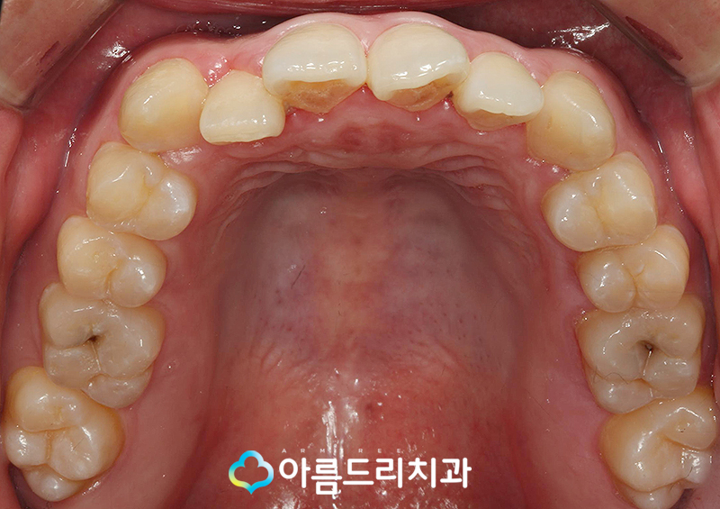 투명교정장치 인비절라인 치과 후기 관련 이미지 6