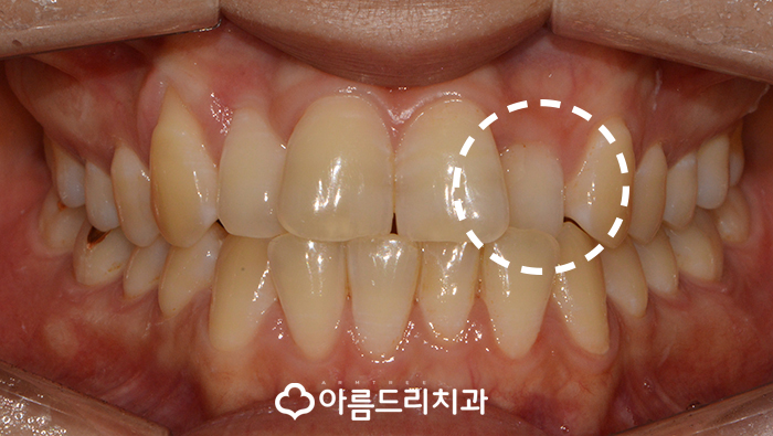 토끼이빨교정 앞니문제 해결 관련 이미지 3