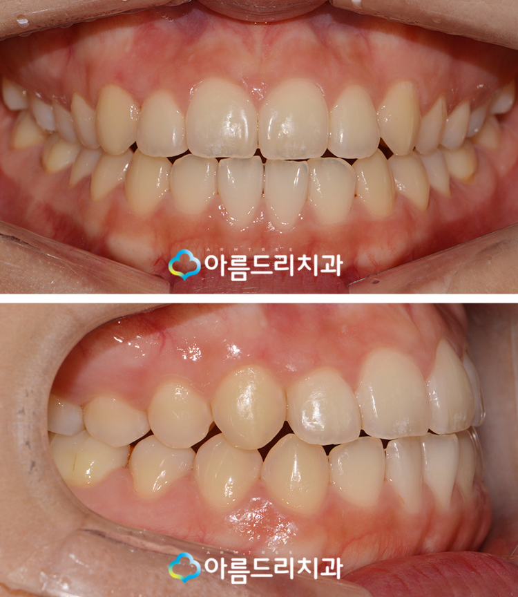 덧니교정 빠르게 부분만 관련 이미지 7