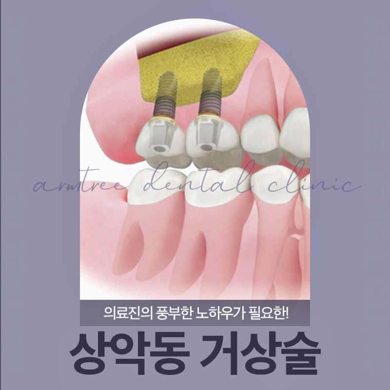 상악동거상술 통증이 걱정된다면 관련 이미지 1