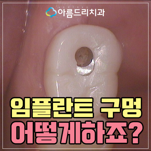 임플란트 구멍(홀)이 났는데 어떻하죠? 관련 이미지 1