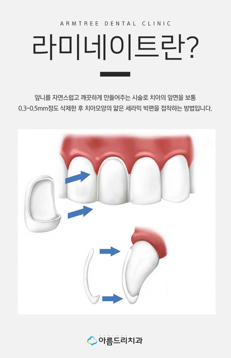 토끼이빨라미네이트 입툭튀 정답은 관련 이미지 2