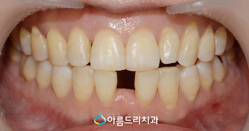 앞니브릿지 치과 치료후기 메릴랜드브릿지 관련 이미지 4