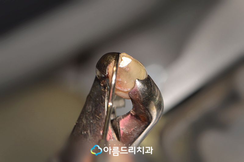 치아재식술 자연치아를지키는 방법 관련 이미지 8