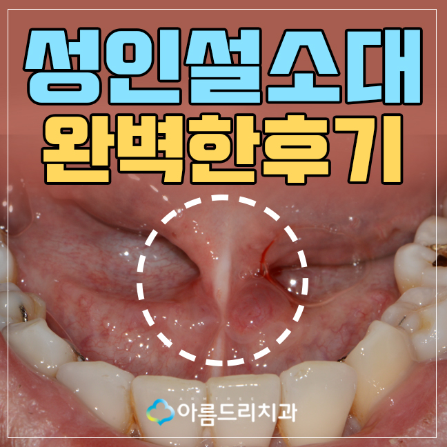 성인 설소대 수술 시술 완벽하게 관련 이미지 1