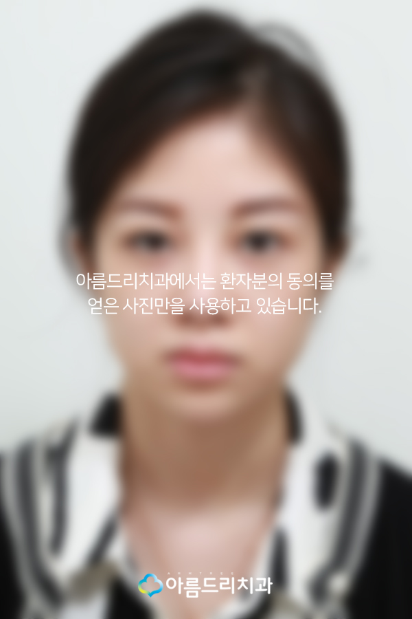 못생긴 앞니 치아라미네이트로 빠르게 관련 이미지 3