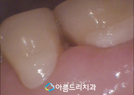 치경부마모증 잇몸파임 시린이 치료 관련 이미지 9