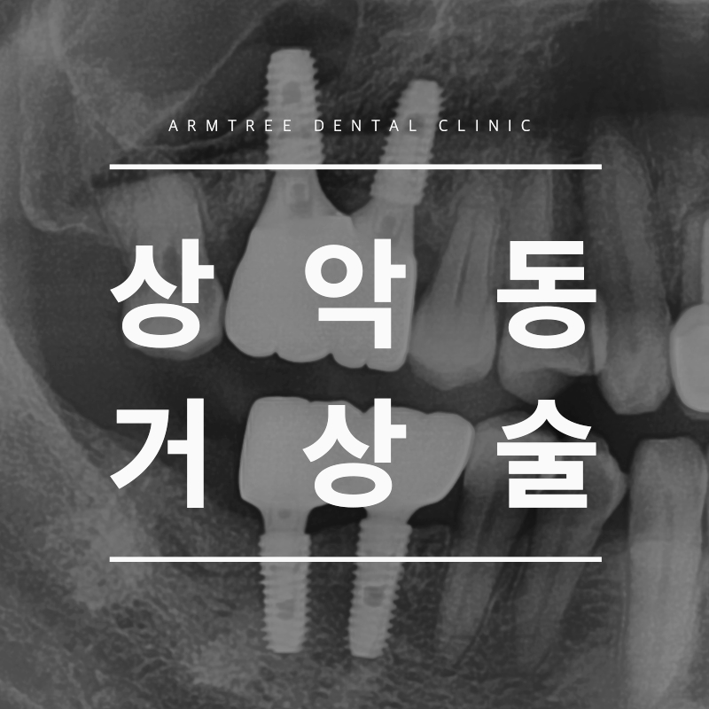 상악동거상술 통증이 걱정된다면 관련 이미지 1