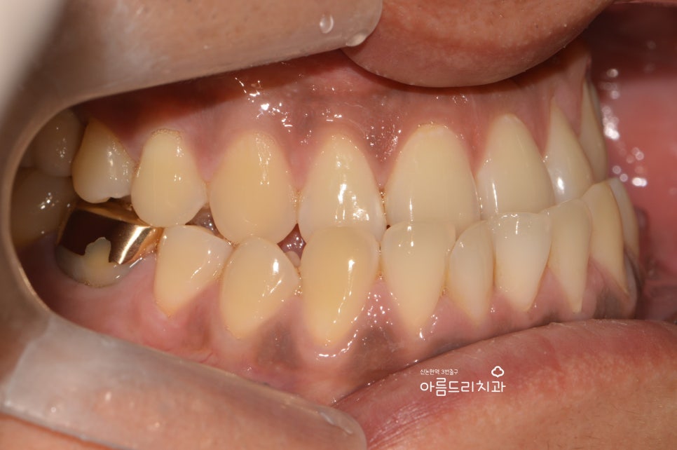 검은 잇몸! 잇몸미백으로 선홍빛 깨끗하게 관련 이미지 7