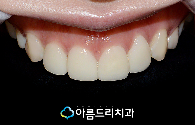 앞니 치아성형 원데이라미네이트 하루만의 기적 관련 이미지 1