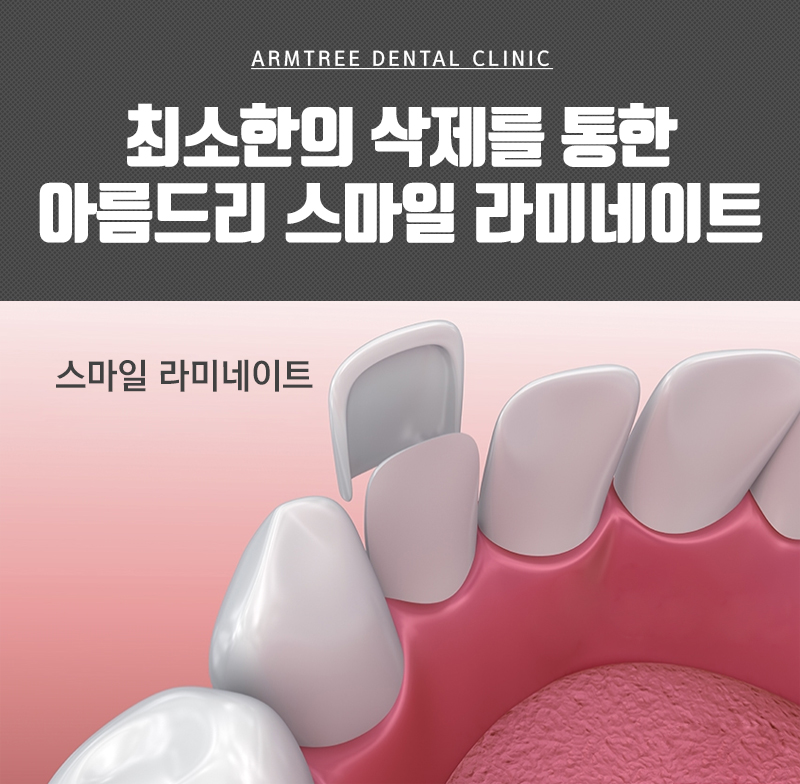 원데이라미네이트 라미네이트연예인 많은곳 관련 이미지 3