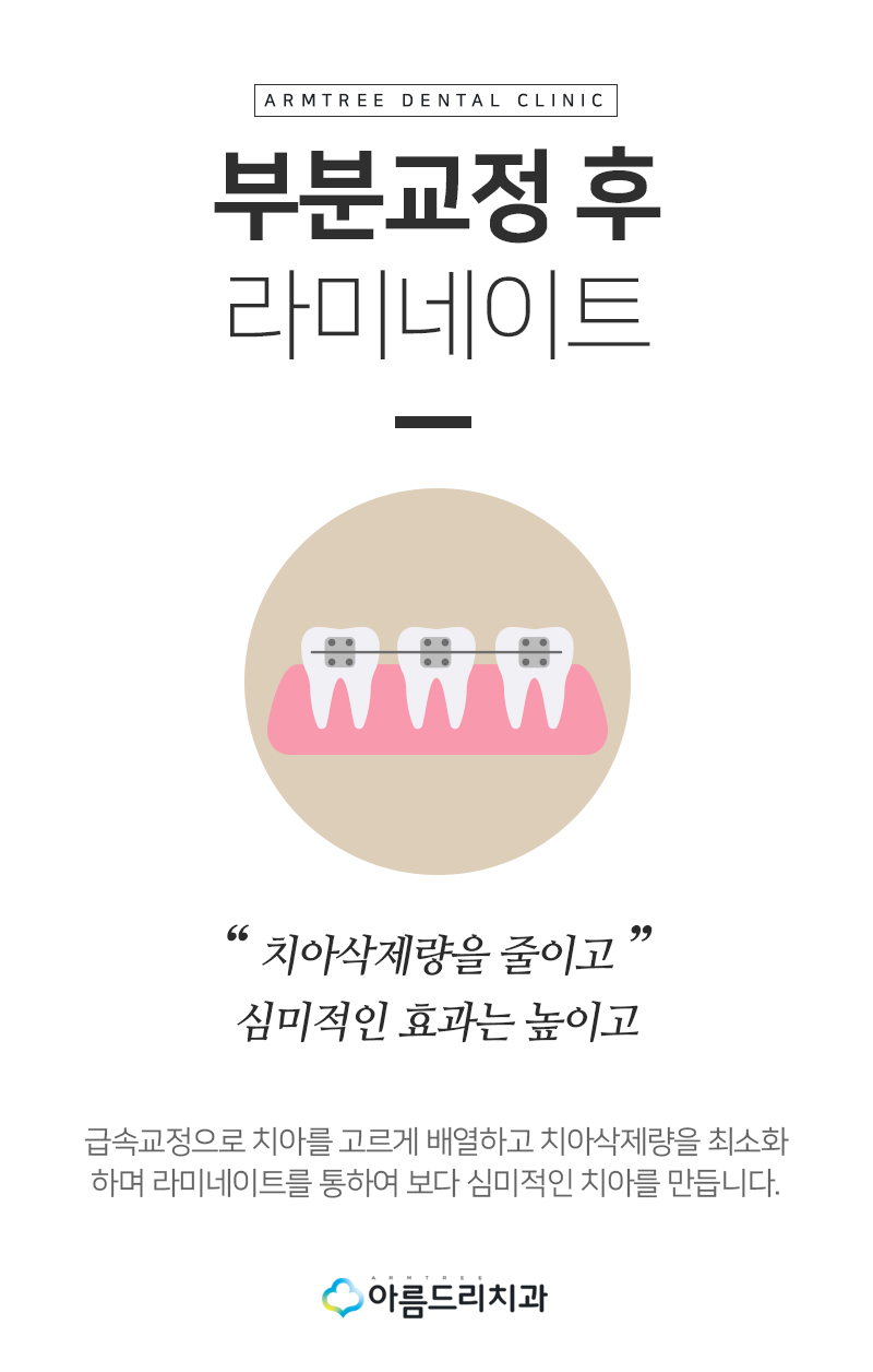 라미네이트교정 최소삭제 치아성형 후기 관련 이미지 5